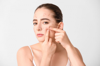 How Long Does Acne Take to Heal With Proper Skincare?