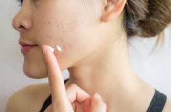 Azelaic Acid for the Long Term: Safety, Benefits, and Tips