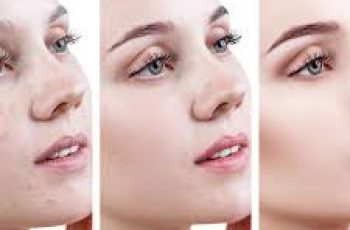 Can You Wear Makeup with Acne-Prone Skin?