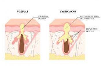 Cystic Acne Explained: Causes, Symptoms, Treatments, and Skincare Solutions