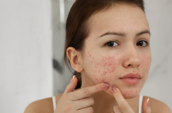 Say Goodbye to Blind Pimples: Expert Tips for Clearer Skin