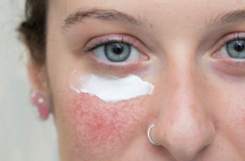 Azelaic Acid and Moisturizer: The Perfect Pair for Clearer, Brighter Skin